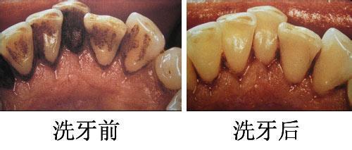 牙龈出血洗牙有用吗